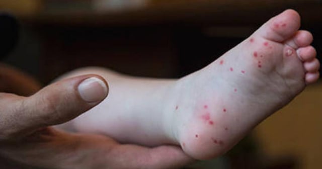 Alerta por casos de enfermedad de manos, pies y boca en niños de Holguín