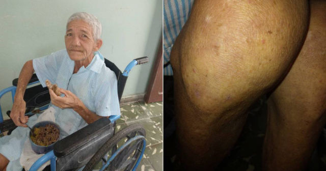 Enorme plaga de chinches en hogar de ancianos de Manzanillo