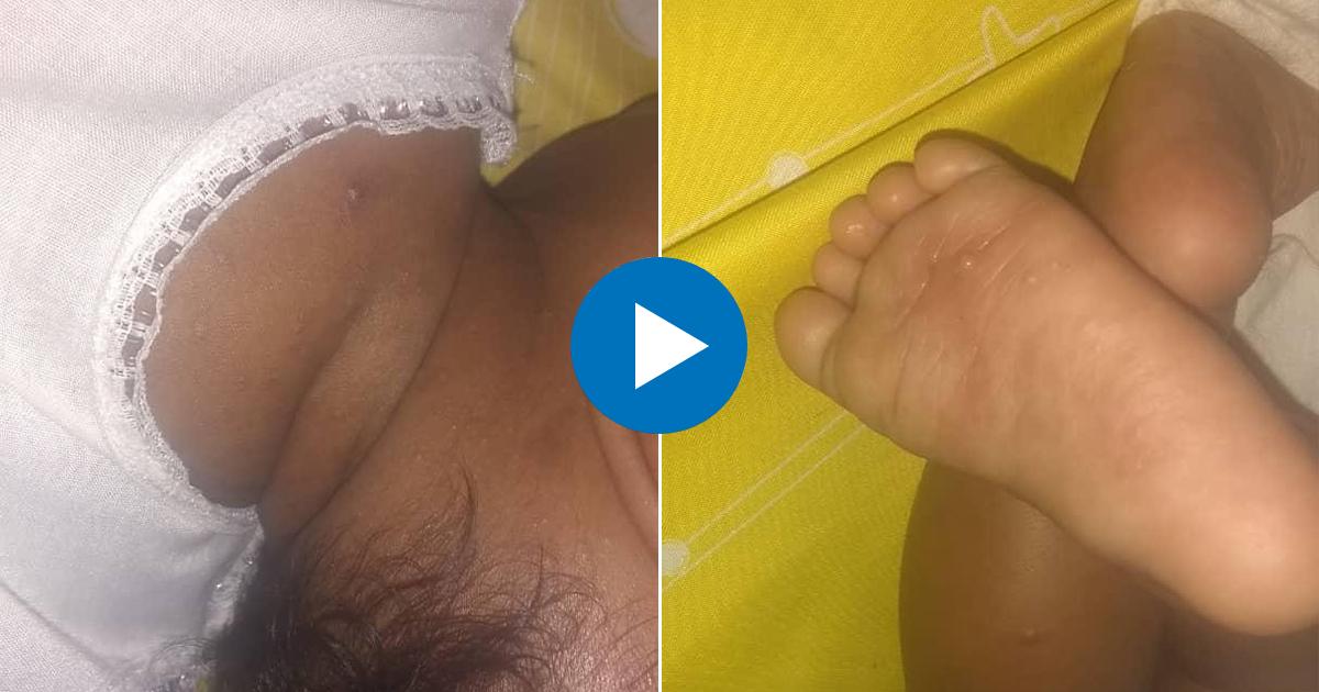 Lesiones cutáneas en pequeña bebé de tres meses © Facebook / José Batista Falcón