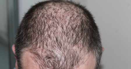 ¿Problemas de alopecia?: Este es el destino preferido por los cubanos en EE.UU. para trasplantes capilares