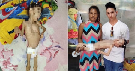 Niña con parálisis cerebral y desnutrición crónica, sin apoyo del Gobierno en Guantánamo