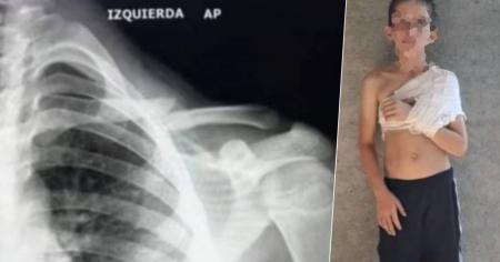 Niño cubano pide ayuda para ser operado en Cuba por fractura de clavícula