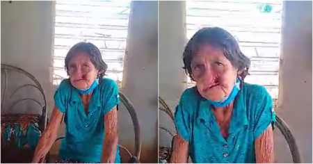 El rostro del abandono: Mujer con cáncer de nariz en Gibara sin acceso a tratamiento