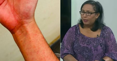 Cuba reporta 55 muertes y 43 casos graves por arbovirosis, según el MINSAP