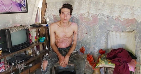 Sobrevivió a una descarga de 33.000 voltios en el Servicio Militar y hoy vive olvidado por el régimen