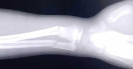 «En el hospital tampoco había yeso»: denuncian falta de material para atender a un niño en Matanzas