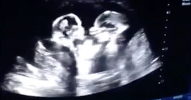Captan en una ecografía "la pelea" de dos bebés en el vientre de su madre
