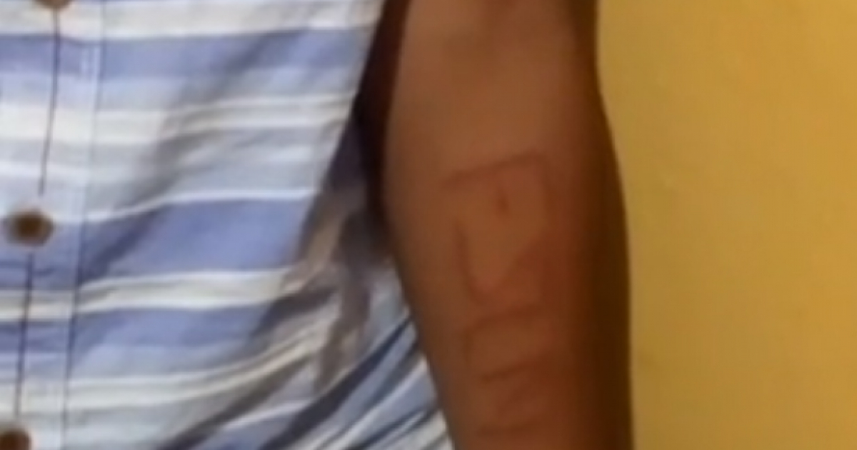 Imagen del brazo del dolescente de 14 años © Captura de video Facebook