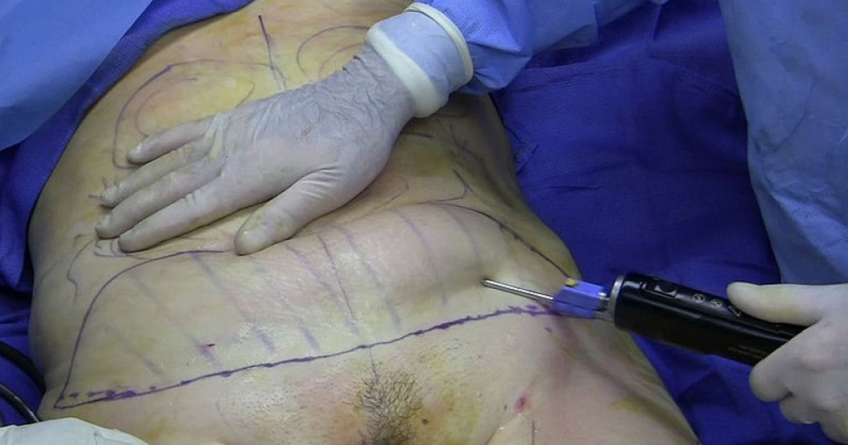 Cirugía de liposucción. © Wikimedia