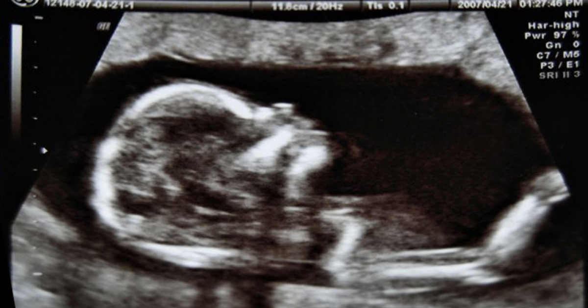 Ecografía de un feto de 14 semanas © Wikipedia 