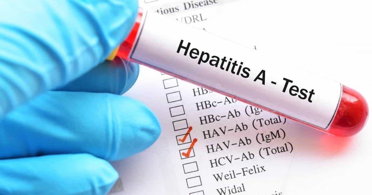 Examen para detectar la Hepatitis A © Flickr / Creative Commons