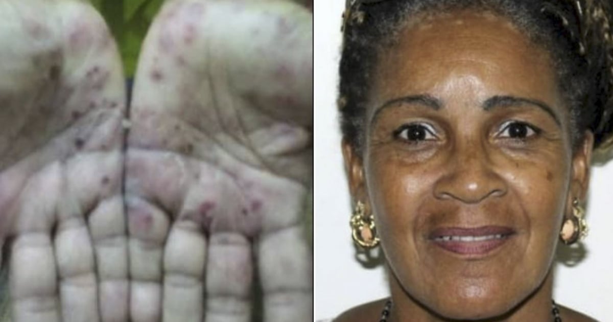 Lesiones en las manos de Xiomara Cruz y ella en una foto de archivo © Facebook / Berta Soler