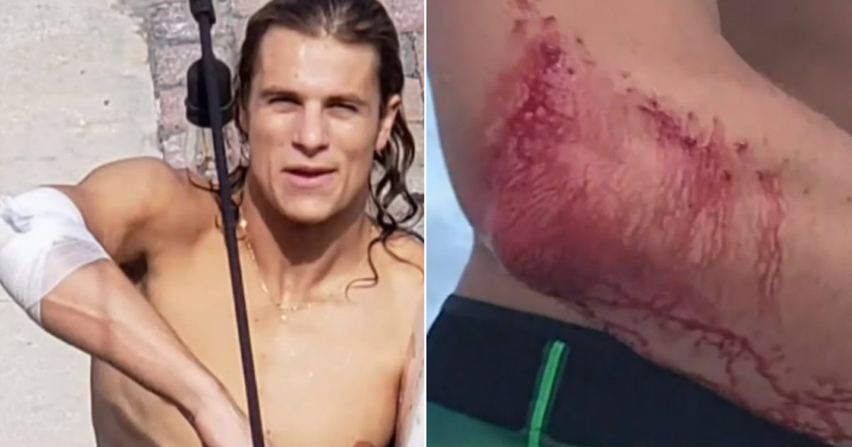 Herida en el brazo del surfista Frank O’Rourke © Telemundo 51