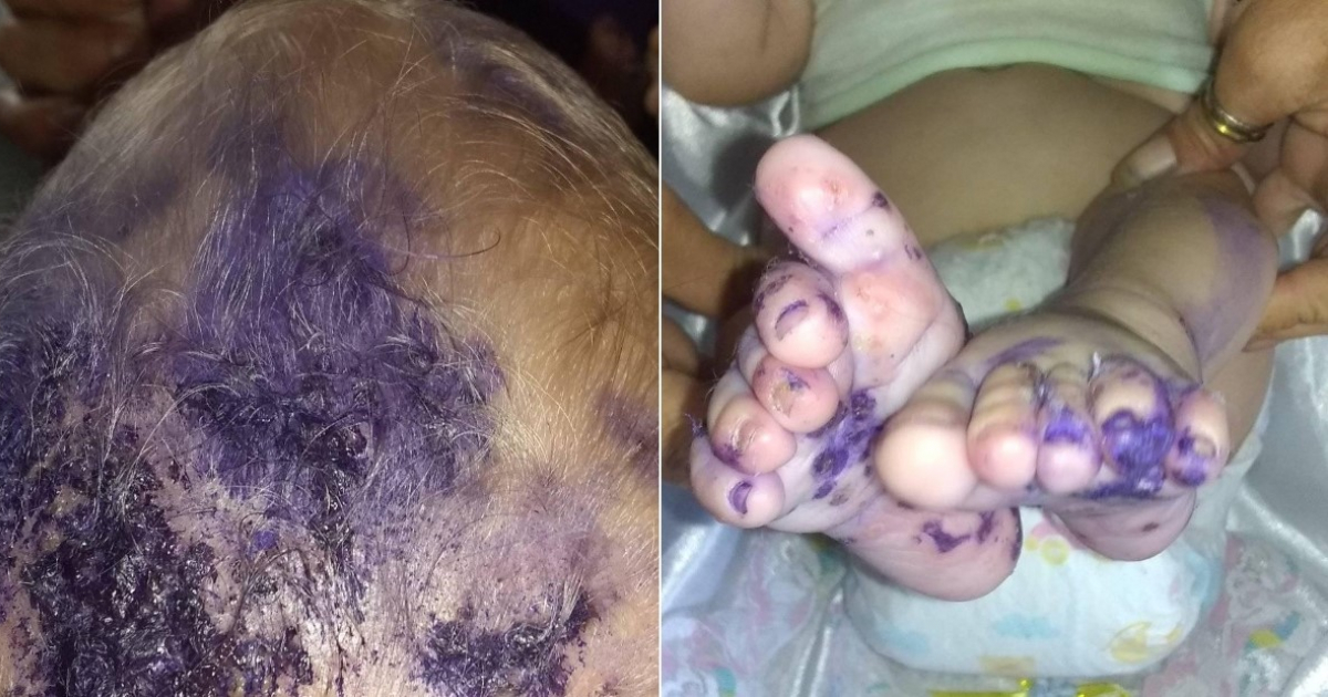 Bebé con enfermedad en la piel © Facebook / José Batista Falcón