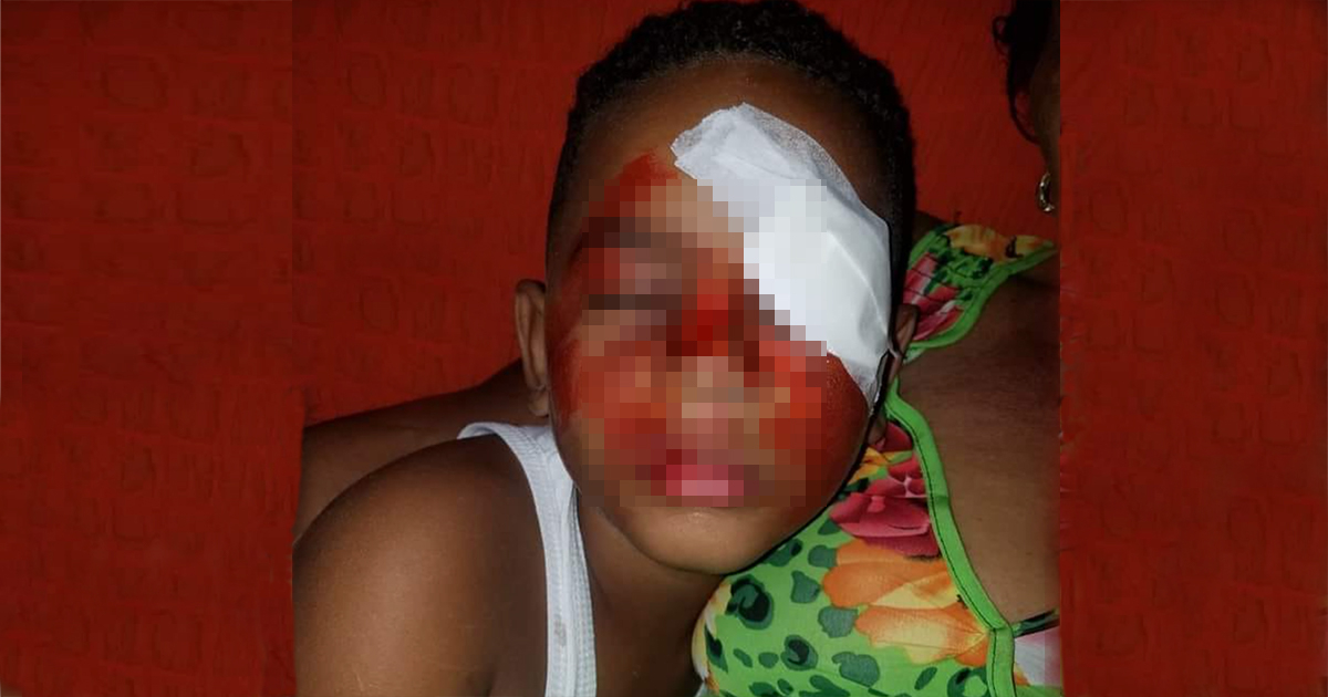 Niño con quemaduras en la cara © Facebook / Diasniurka Salcedo Ramos