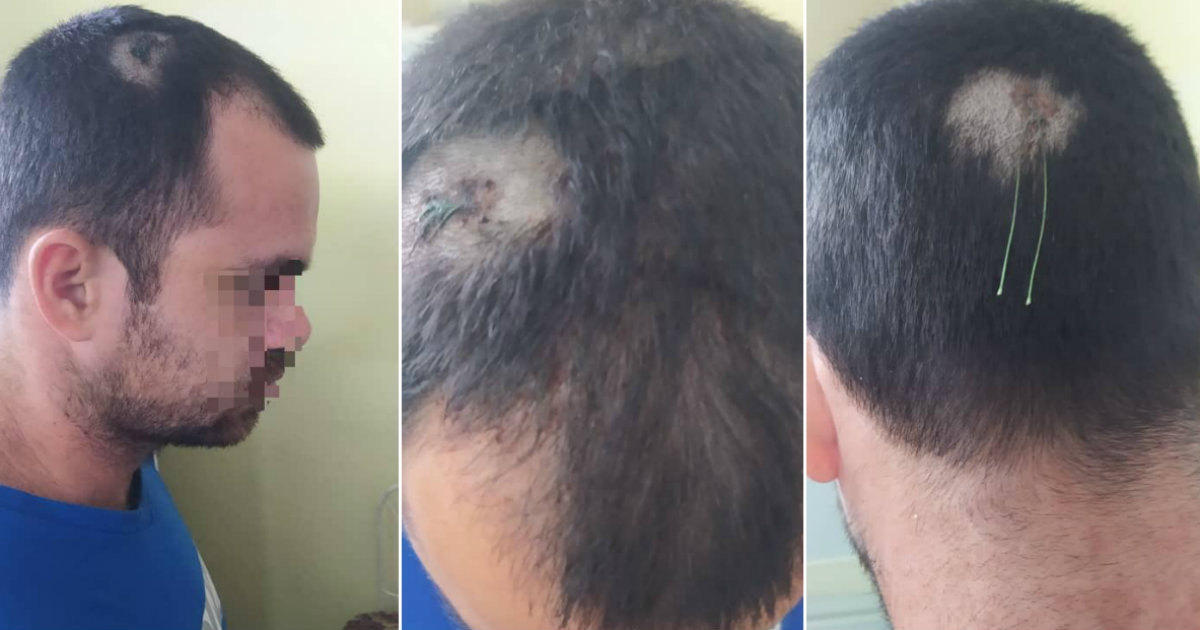 Heridas recibidas en la cabeza. © CiberCuba