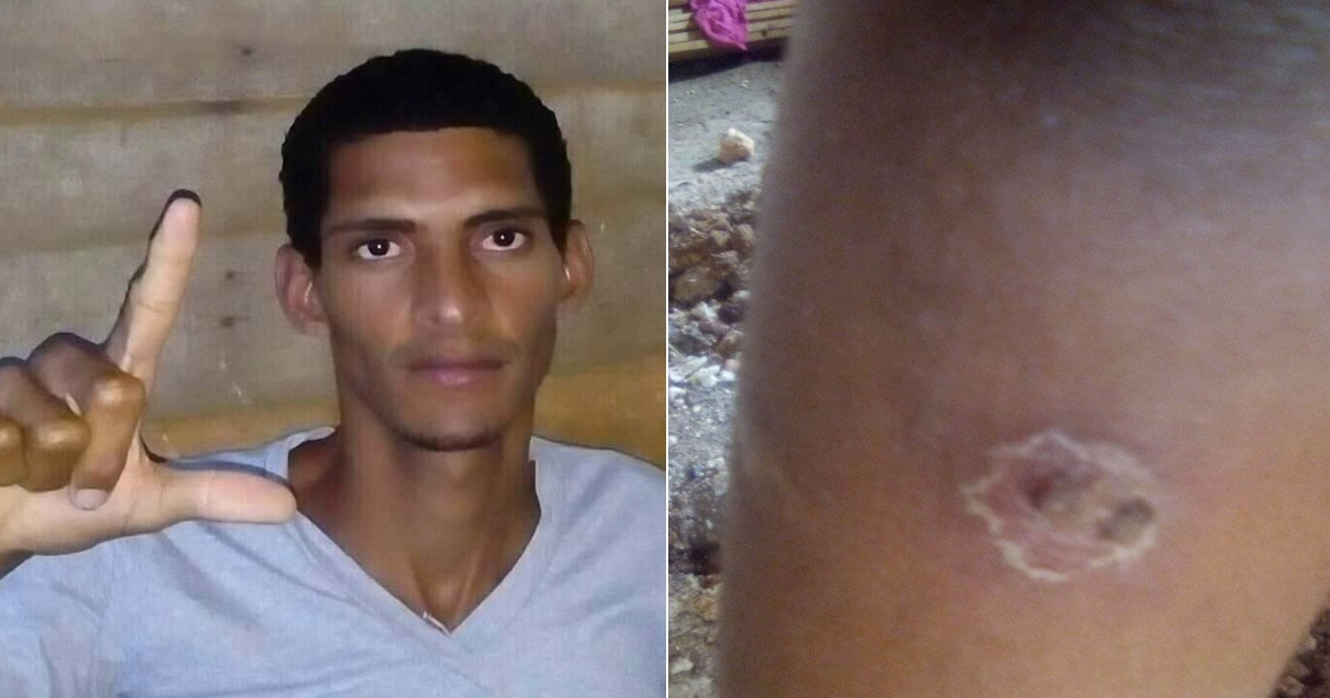Yoel Acosta Games, activista cubano, y una de las lesiones en la piel de su hijo © Facebook / Yoel Acosta Games,