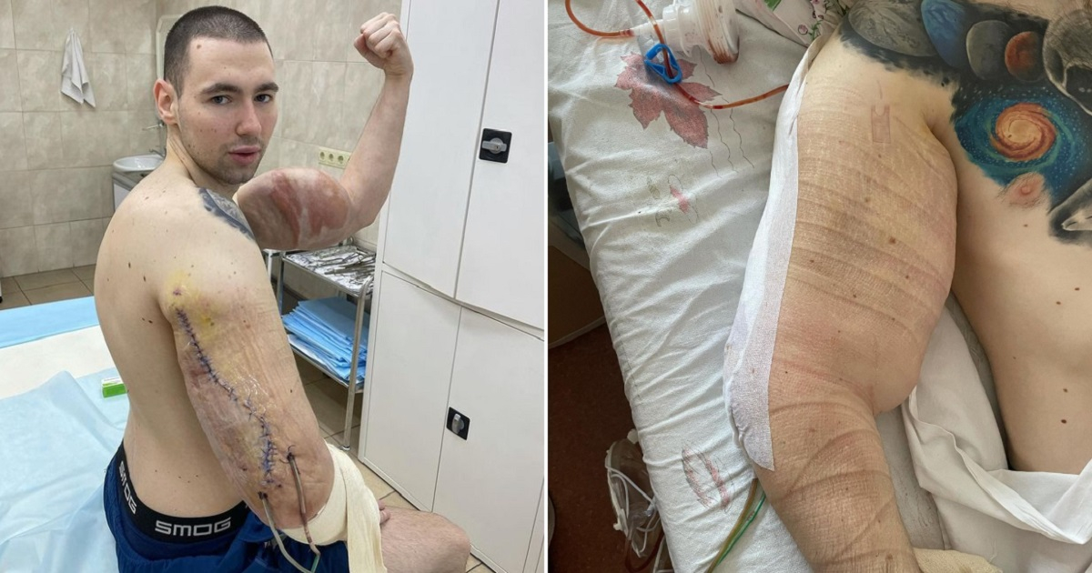Kirill Tereshin muestra cicatrices de la operación en el brazo © Instagram / Kirill Tereshin 