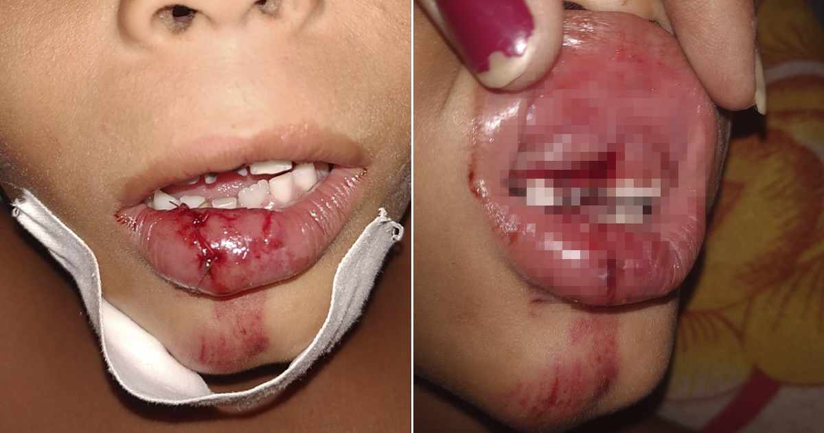 Menor afectado por una infección bucal tras rotura del labio inferior y la encía superior © Facebook / Yacnely Cardoso