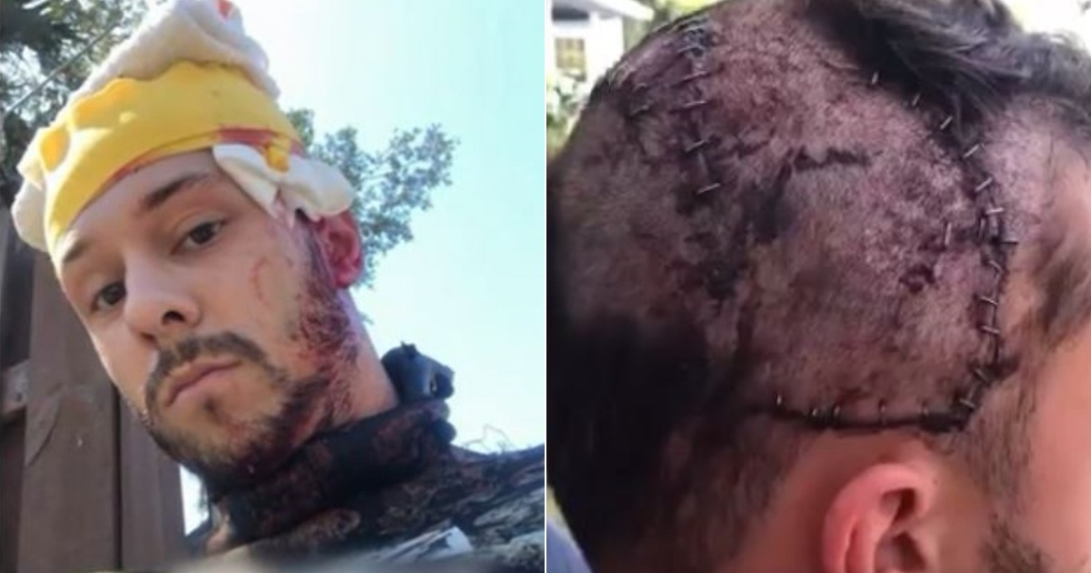 Jeffrey Heim, el joven de 25 años que fue víctima de un cocodrilo (i) y Cicatrices que le dejó las mordidas del cocodrilo en la cabeza (d) © Collage YouTube/screenshot-FOX 13 Tampa Bay