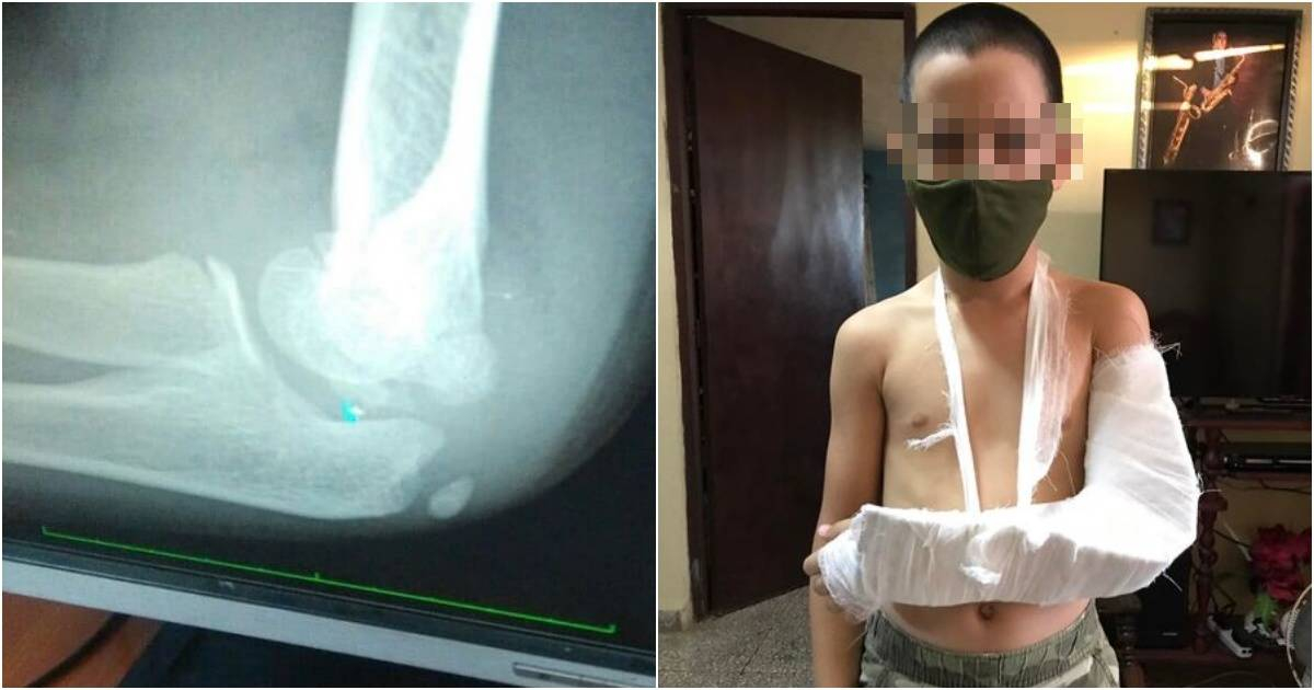falta de yeso en hospital para atender fractura de codo de niño. © Facebook/Jorge Franco