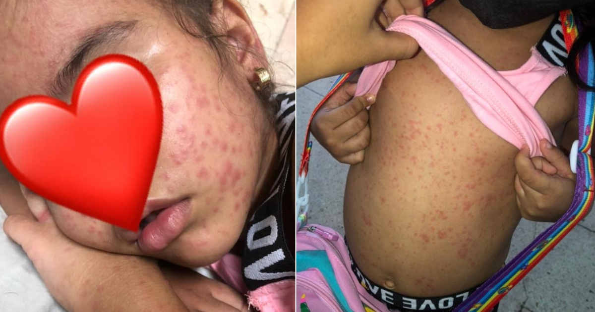 Infección por bacteria en niña de 4 años © Facebook / El Chago - Santiago de Cuba