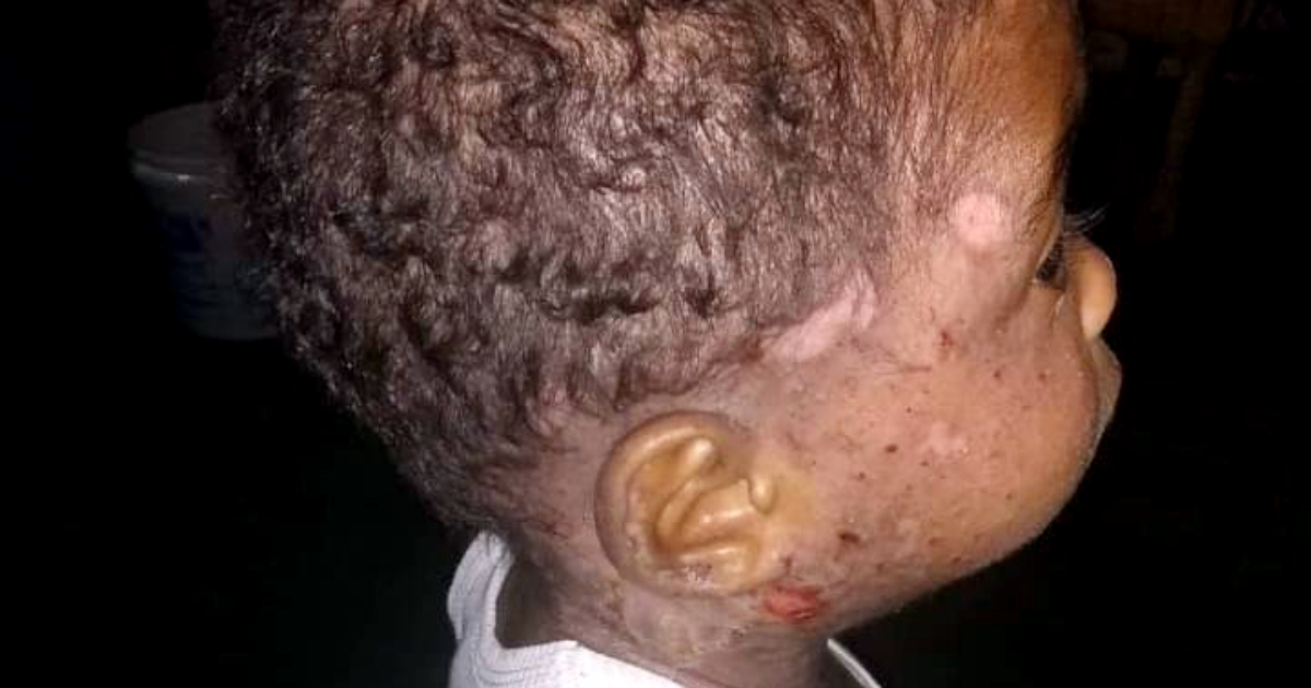Niño cubano aquejado de una dermatitis atópica seborreica © Facebook / Rayitos de Esperanza