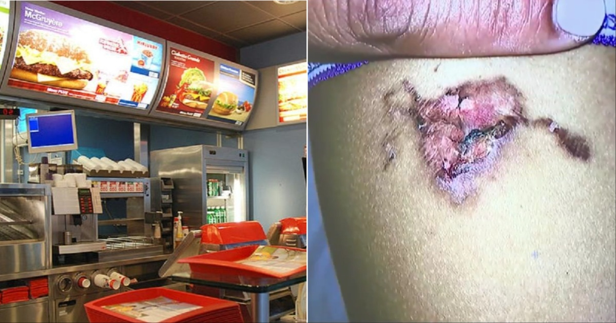 McDonald's y pierna con quemadura © Captura de video / NBC Miami