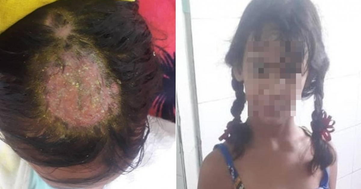 Niña enferma y su cabeza con el estafilococo © Denunciando los crímenes en Cuba / Facebook / Michaela Días García