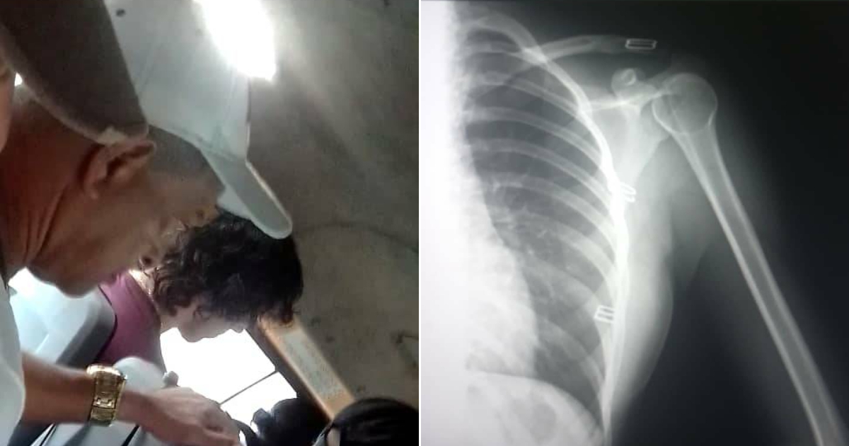 Agresor de estudiante (con gorra) y radiografía de la lesión que le infligió en el hombro © Facebook/Hector Eduardo Crespo