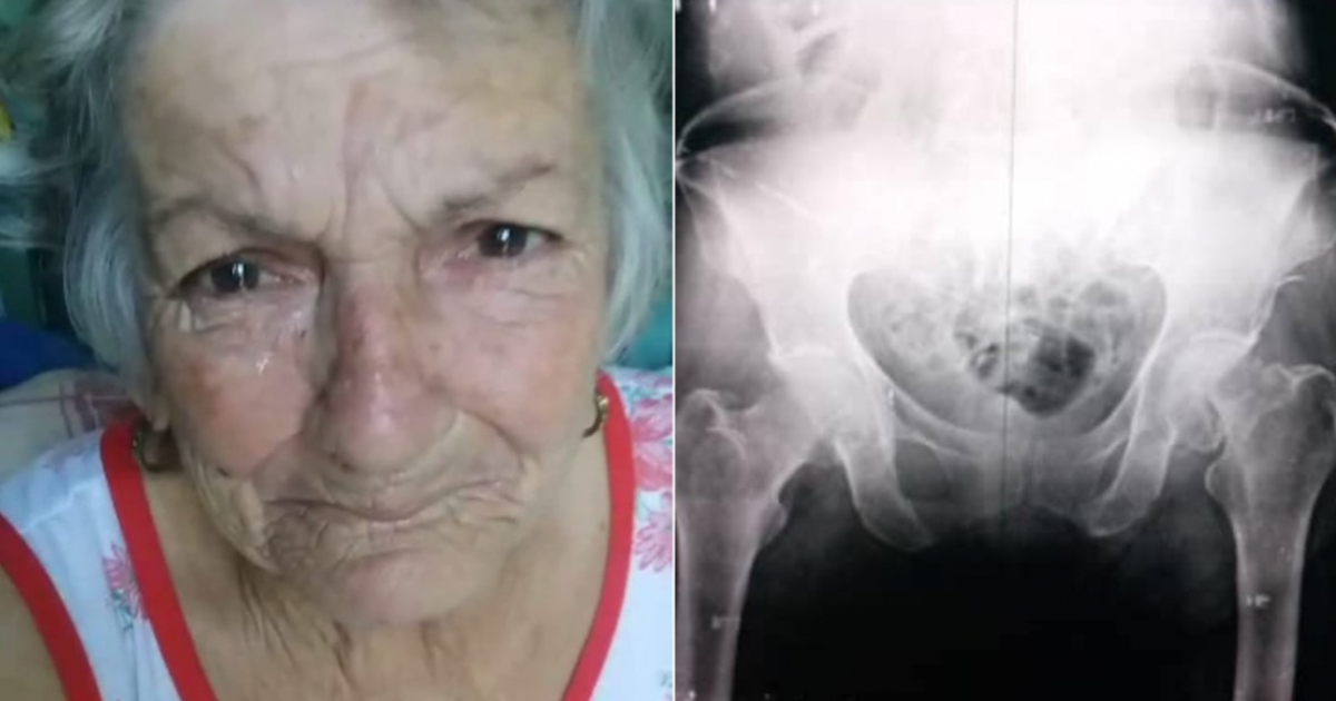 Anciana necesita ser operada tras una fractura de cadera © Facebook/Yusimy Hernandez en CAMAJUANÍ 24/7 (OFICIAL)