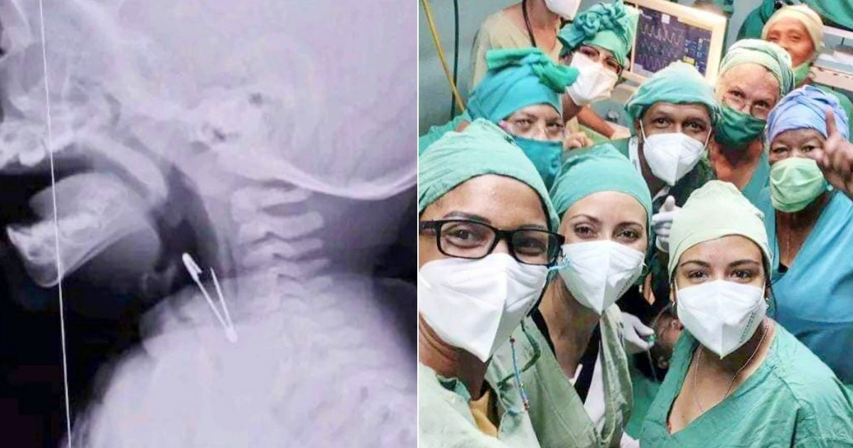 Radiografía que muestra al alfiler en la garganta del bebé (i) y Personal sanitario que intervino en la operación (d) © Collage Facebook/Dirección Provincial de Salud de Santiago de Cuba