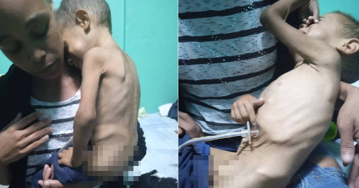Niño cubano con desnutrición © Facebook/Giselle Baro