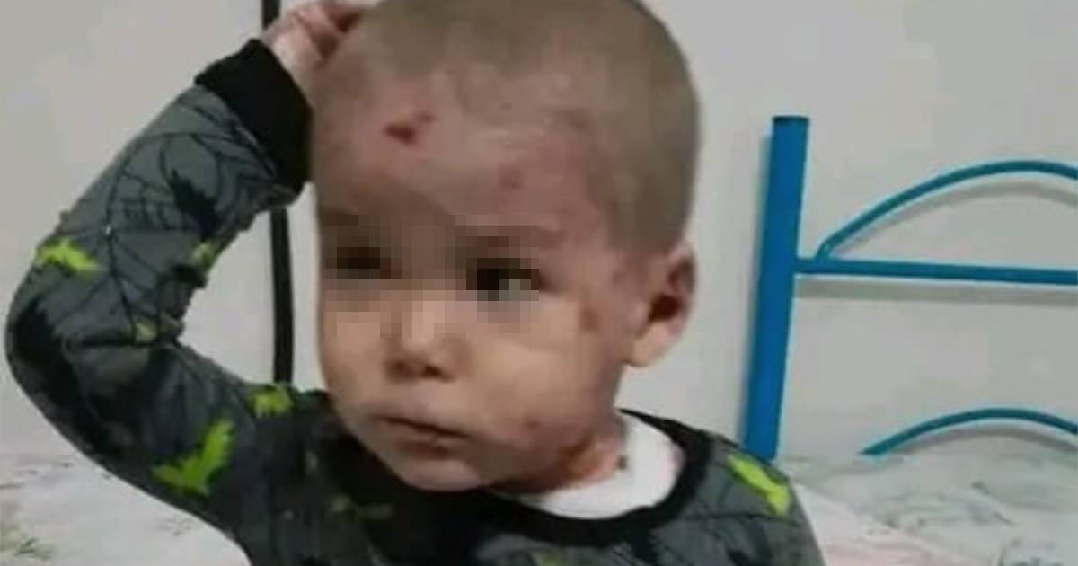 Child with "Butterfly Skin" Disease in Pinar del Río Seeks Urgent Help