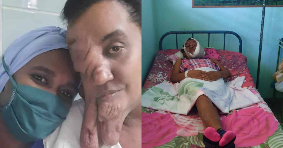 Cuban Woman Recovers After Complex Facial Tissue Removal