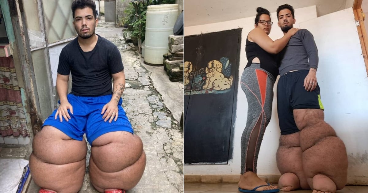 Young Cuban with Elephantiasis Needs $2,000 for Surgery in Spain: "I Can No Longer Walk"