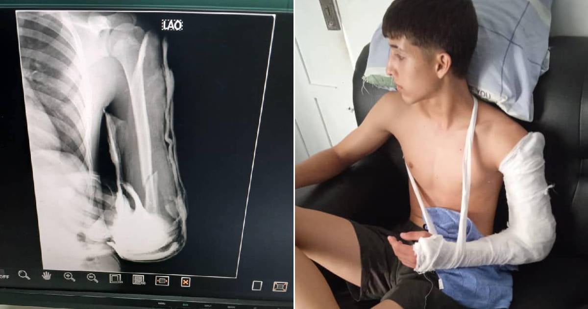 Police Violence in Holguín: Teen's Arm Broken During Soccer Game Arrest