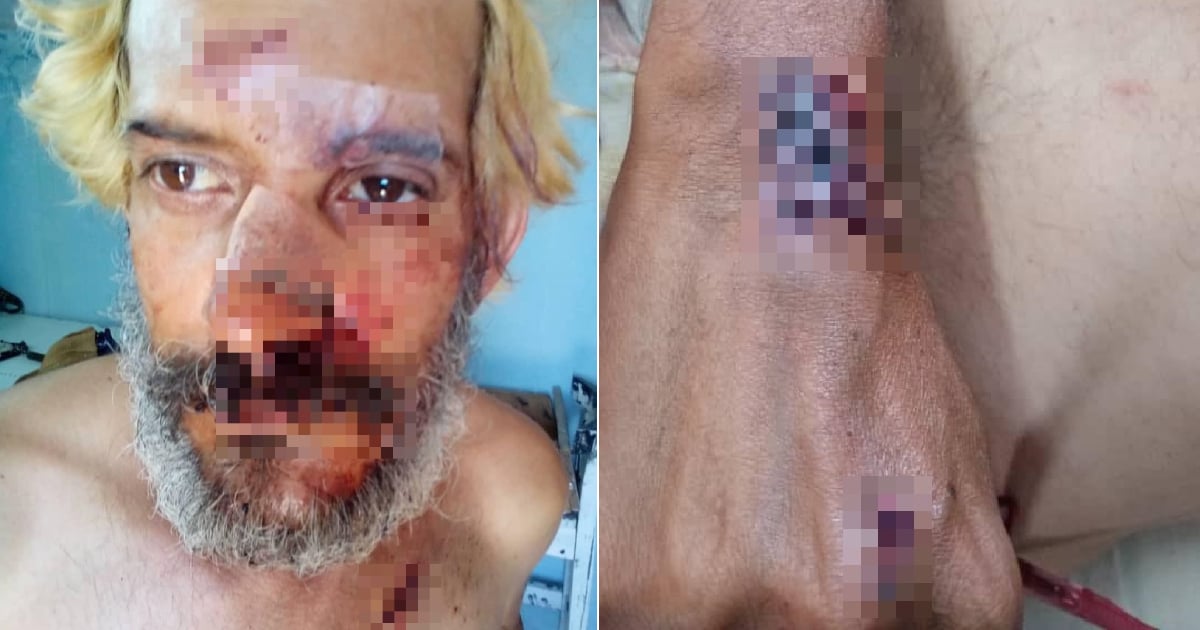 Cuban Musician Eduardo "El Longa" Severely Injured in Vicious Havana Mugging