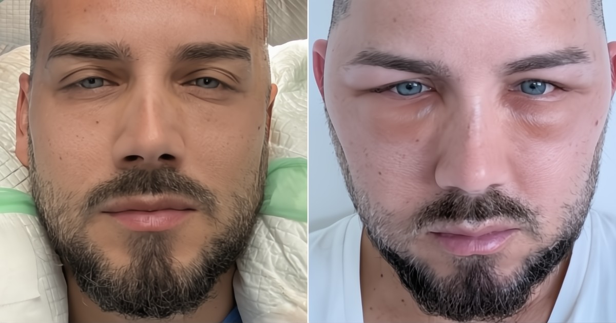 Cuban Singer El Boni's New Look: Hair Transplant Transformation in Miami
