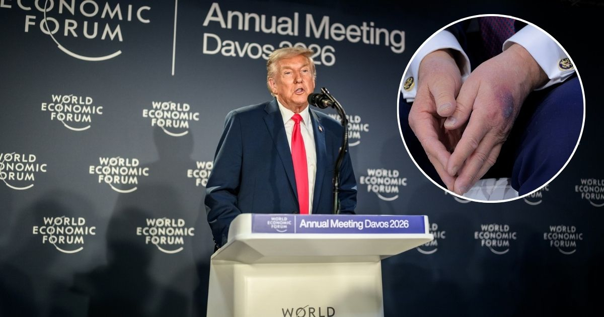 Trump's Bruised Hand Explained by White House: What Happened and Why