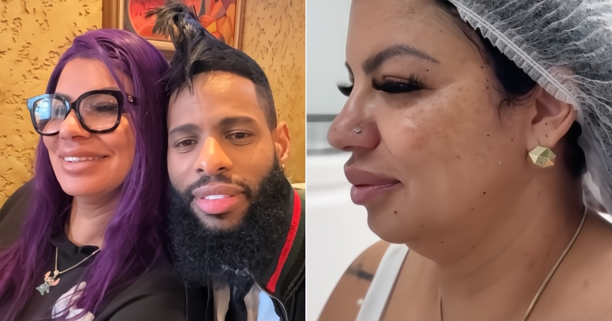 The Dramatic Transformation of El Yonki's Wife After Facial Procedure