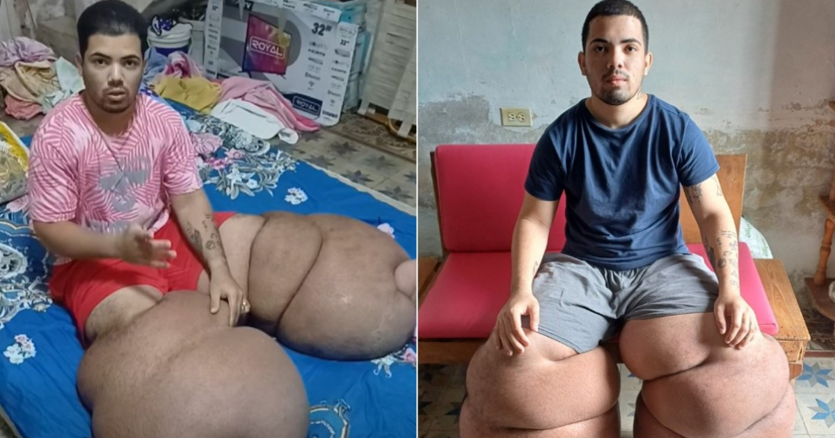 "Stop defaming": Young Cuban with lymphedema breaks the silence and explains why he has been unable to leave Cuba for surgery