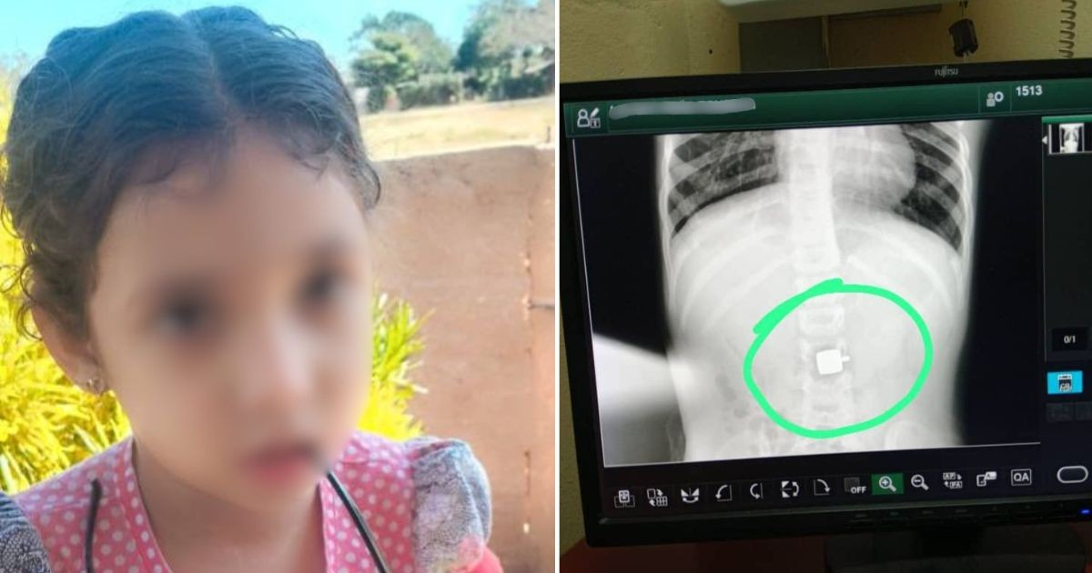 A Frightening Incident: Girl with Cerebral Palsy in Matanzas Accidentally Swallows Pendant