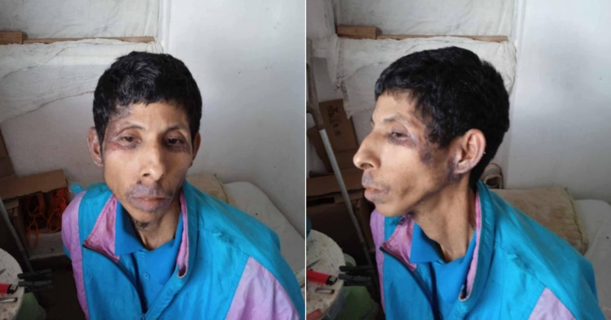 Urgent Plea for Autistic Youth Facing Tissue-Devouring Infection: "Health System Has Sent Him Home to Die"
