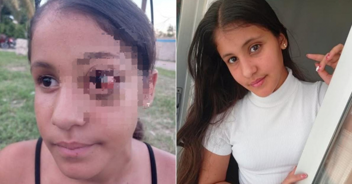 Cuban Girl Triumphs Over Eye Tumor After Successful Treatment in Madrid