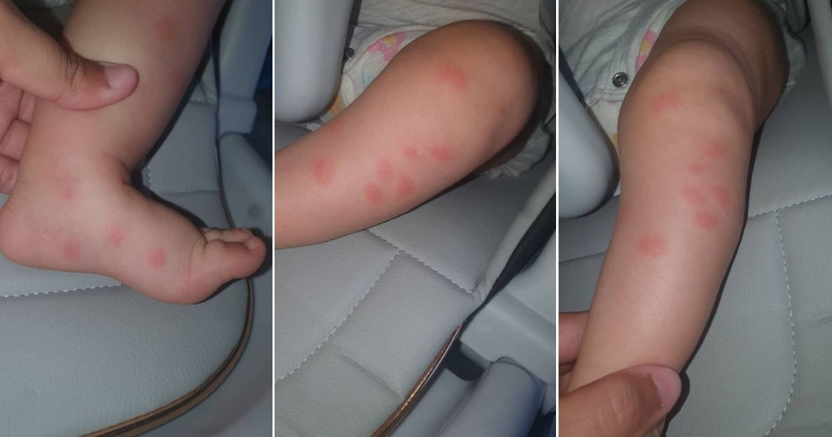 Mother's Heartbreaking Post Highlights Mosquito Bites All Over Her Baby Due to Cuba's Power Outages