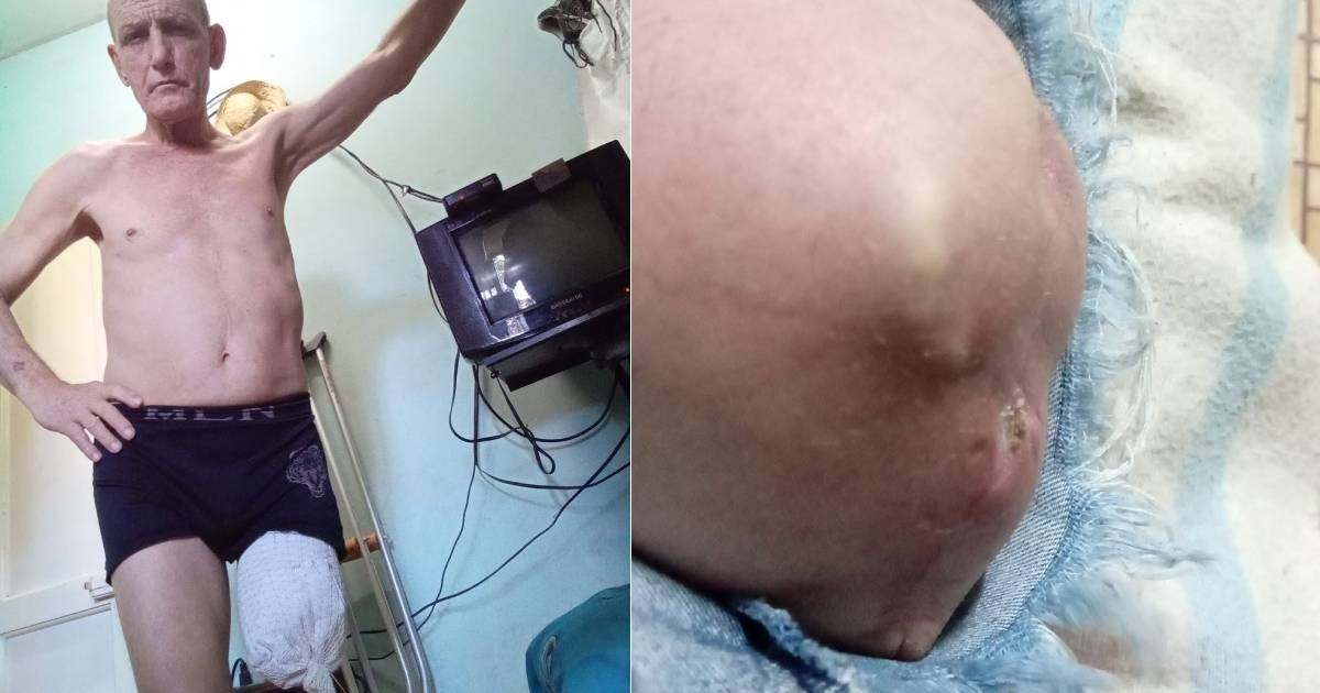 Amputee in Cuba Relies on Neighbors for Survival Amid Desperation
