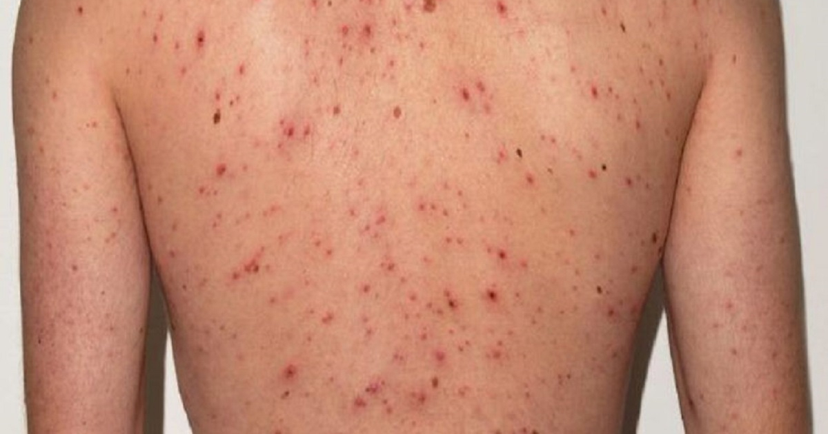 Florida Ranks Among Top Five States for Measles Cases in 2026