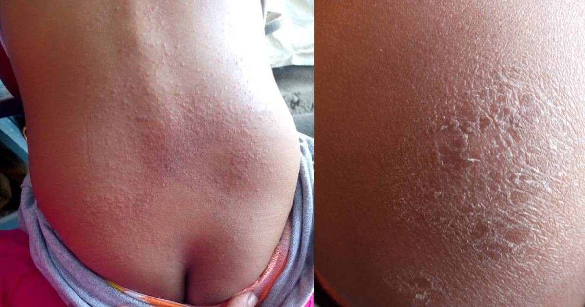 Cuban Mother Highlights Dire Impact of Water Shortage on Her Daughter's Health