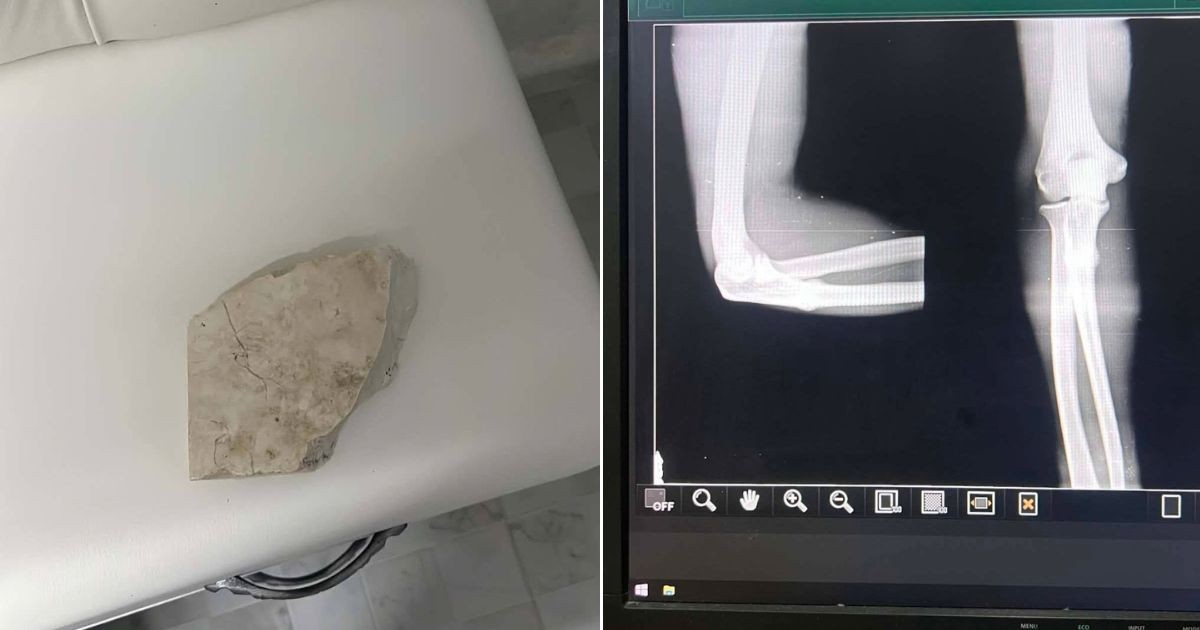 La víctima asegura que fue golpeada con un fragmento de mármol © Collage Facebook/José L. Tan Estrada